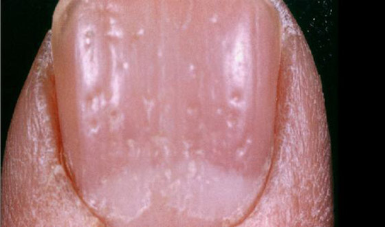 أظافرك مرآة لصحتك.. لون وشكل وملمس الأظافر يكشفون الأمراض! صورة رقم 10 أظافرك مرآة لصحتك.. لون وشكل وملمس الأظافر يكشفون الأمراض! صورة رقم 10