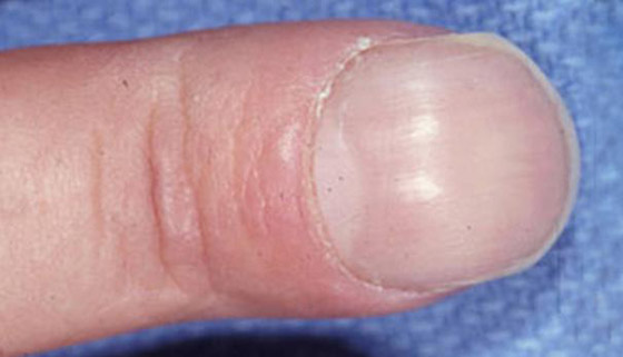 أظافرك مرآة لصحتك.. لون وشكل وملمس الأظافر يكشفون الأمراض! صورة رقم 11 أظافرك مرآة لصحتك.. لون وشكل وملمس الأظافر يكشفون الأمراض! صورة رقم 11