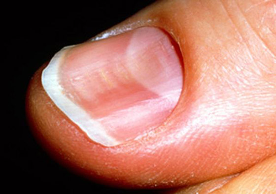 أظافرك مرآة لصحتك.. لون وشكل وملمس الأظافر يكشفون الأمراض! صورة رقم 12 أظافرك مرآة لصحتك.. لون وشكل وملمس الأظافر يكشفون الأمراض! صورة رقم 12