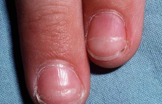 أظافرك مرآة لصحتك.. لون وشكل وملمس الأظافر يكشفون الأمراض! صورة رقم 13 أظافرك مرآة لصحتك.. لون وشكل وملمس الأظافر يكشفون الأمراض! صورة رقم 13