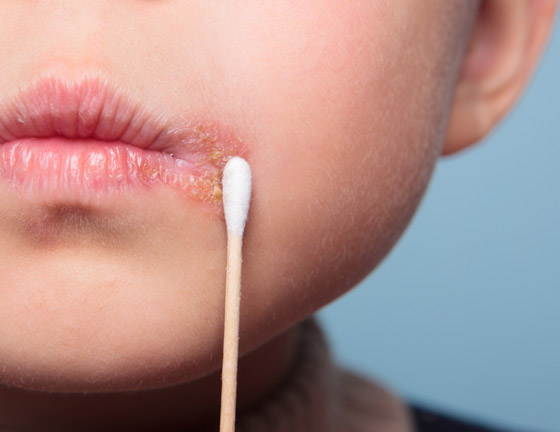 هكذا تعالجون قروح البرد أو بثور الحمى بطرق طبيعية صورة رقم 5