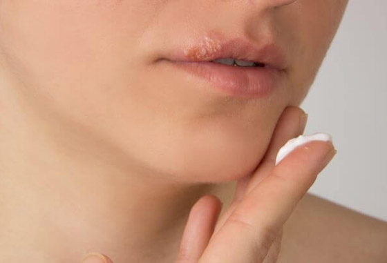 هكذا تعالجون قروح البرد أو بثور الحمى بطرق طبيعية صورة رقم 1