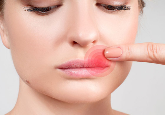 هكذا تعالجون قروح البرد أو بثور الحمى بطرق طبيعية صورة رقم 4