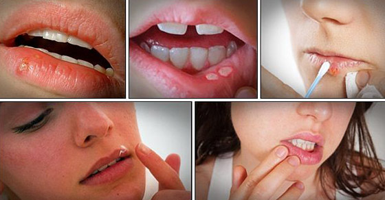 هكذا تعالجون قروح البرد أو بثور الحمى بطرق طبيعية صورة رقم 11