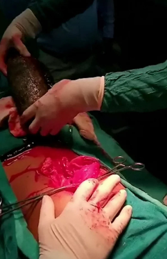 أطباء يسحبون كتلة شعر ضخمة بوزن 7 كغ من معدة فتاة! صورة رقم 3