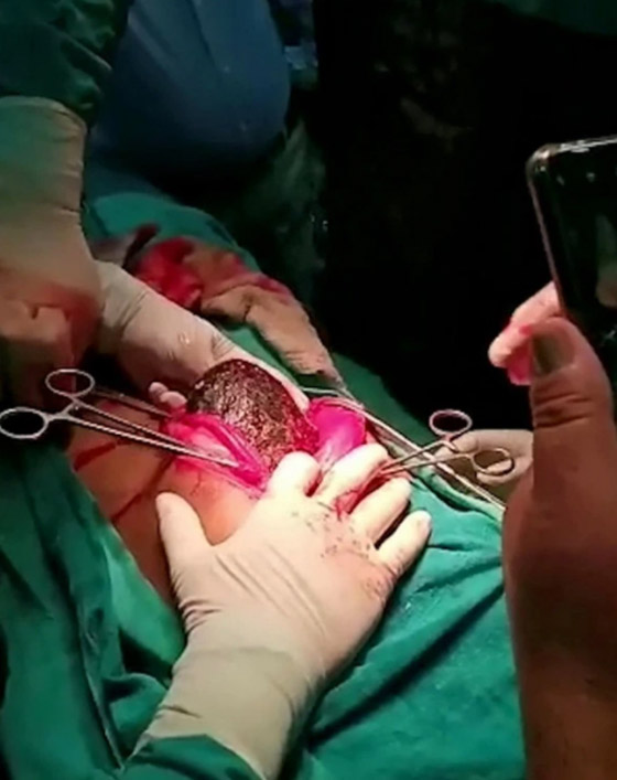 أطباء يسحبون كتلة شعر ضخمة بوزن 7 كغ من معدة فتاة! صورة رقم 4