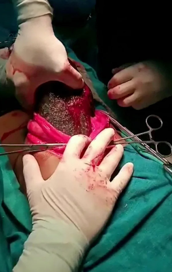 أطباء يسحبون كتلة شعر ضخمة بوزن 7 كغ من معدة فتاة! صورة رقم 2