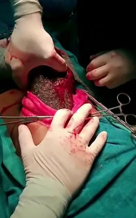 أطباء يسحبون كتلة شعر ضخمة بوزن 7 كغ من معدة فتاة! صورة رقم 5