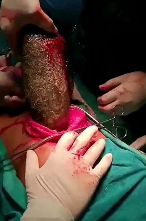 أطباء يسحبون كتلة شعر ضخمة بوزن 7 كغ من معدة فتاة! صورة رقم 6