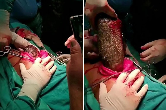 أطباء يسحبون كتلة شعر ضخمة بوزن 7 كغ من معدة فتاة! صورة رقم 1