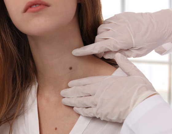 ارتبطت بها الخرافات والأساطير.. إليكم كل ما يخبرنا به العلم عن الوحمات صورة رقم 1