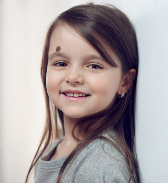 ارتبطت بها الخرافات والأساطير.. إليكم كل ما يخبرنا به العلم عن الوحمات صورة رقم 2