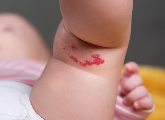 ارتبطت بها الخرافات والأساطير.. إليكم كل ما يخبرنا به العلم عن الوحمات صورة رقم 3