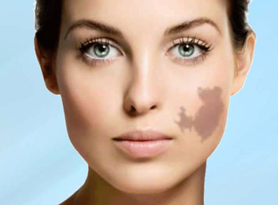 ارتبطت بها الخرافات والأساطير.. إليكم كل ما يخبرنا به العلم عن الوحمات صورة رقم 8