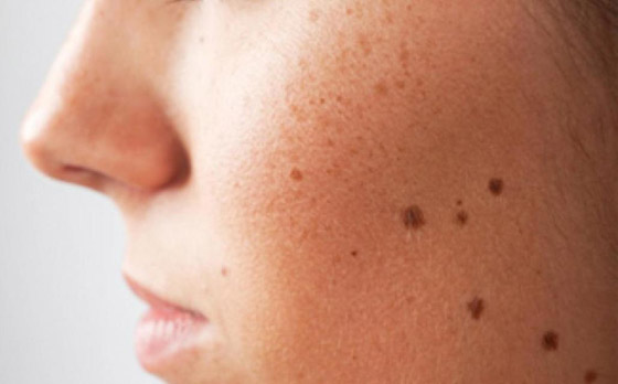 ارتبطت بها الخرافات والأساطير.. إليكم كل ما يخبرنا به العلم عن الوحمات صورة رقم 12