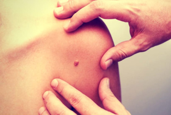 ارتبطت بها الخرافات والأساطير.. إليكم كل ما يخبرنا به العلم عن الوحمات صورة رقم 13