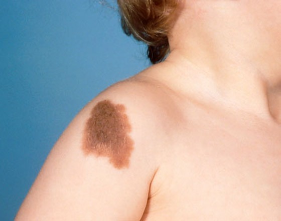 ارتبطت بها الخرافات والأساطير.. إليكم كل ما يخبرنا به العلم عن الوحمات صورة رقم 4