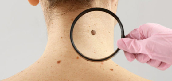 ارتبطت بها الخرافات والأساطير.. إليكم كل ما يخبرنا به العلم عن الوحمات صورة رقم 14