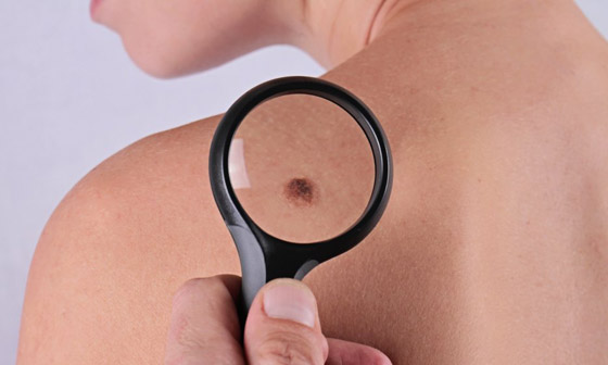 ارتبطت بها الخرافات والأساطير.. إليكم كل ما يخبرنا به العلم عن الوحمات صورة رقم 5