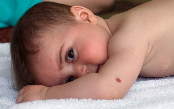 ارتبطت بها الخرافات والأساطير.. إليكم كل ما يخبرنا به العلم عن الوحمات صورة رقم 15