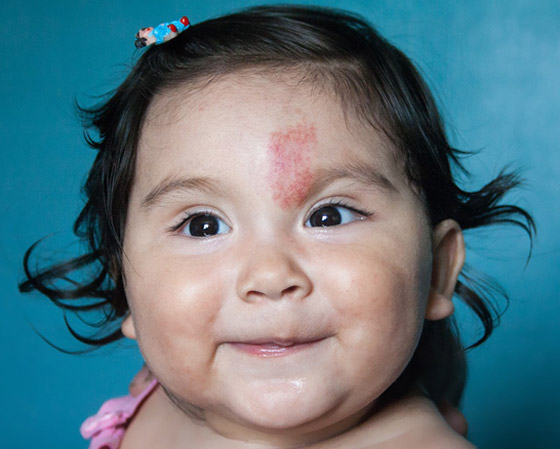 ارتبطت بها الخرافات والأساطير.. إليكم كل ما يخبرنا به العلم عن الوحمات صورة رقم 16