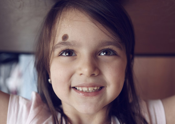 ارتبطت بها الخرافات والأساطير.. إليكم كل ما يخبرنا به العلم عن الوحمات صورة رقم 7