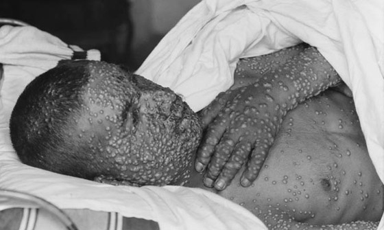 الجدري: المرض الفتاك الذي قتل الملايين وأدى لظهور أول لقاح في العالم صورة رقم 6