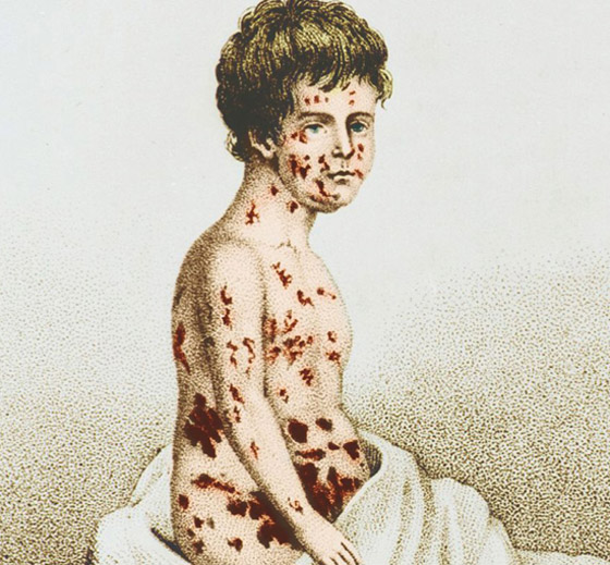 الجدري: المرض الفتاك الذي قتل الملايين وأدى لظهور أول لقاح في العالم صورة رقم 8