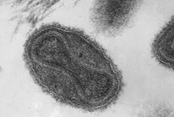 الجدري: المرض الفتاك الذي قتل الملايين وأدى لظهور أول لقاح في العالم صورة رقم 7