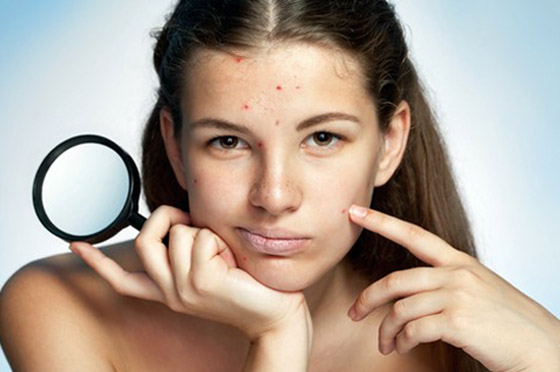 تعرفوا إلى المناطق التي تظهر فيها البثورعلى الوجه ودلالاتها الصحية صورة رقم 3 تعرفوا إلى المناطق التي تظهر فيها البثورعلى الوجه ودلالاتها الصحية صورة رقم 3