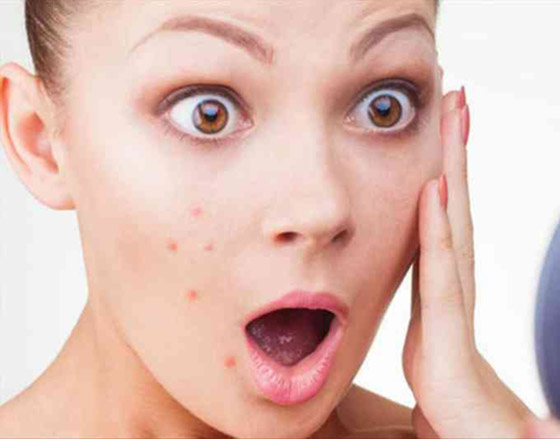 تعرفوا إلى المناطق التي تظهر فيها البثورعلى الوجه ودلالاتها الصحية صورة رقم 7 تعرفوا إلى المناطق التي تظهر فيها البثورعلى الوجه ودلالاتها الصحية صورة رقم 7