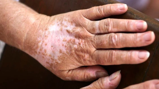 مرض يعاني منه 1% من سكان العالم.. هذه أعراضه وطرق علاجه صورة رقم 1