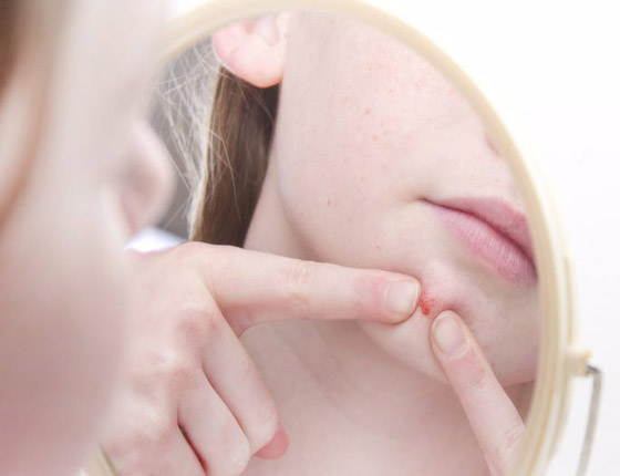 الأمر قد يبدو مقززا.. لكن هل فرقعة البثور وحب الشباب مضرة للجلد حقا؟ صورة رقم 2 الأمر قد يبدو مقززا.. لكن هل فرقعة البثور وحب الشباب مضرة للجلد حقا؟ صورة رقم 2