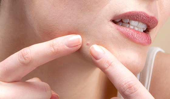 الأمر قد يبدو مقززا.. لكن هل فرقعة البثور وحب الشباب مضرة للجلد حقا؟ صورة رقم 4 الأمر قد يبدو مقززا.. لكن هل فرقعة البثور وحب الشباب مضرة للجلد حقا؟ صورة رقم 4