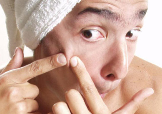 الأمر قد يبدو مقززا.. لكن هل فرقعة البثور وحب الشباب مضرة للجلد حقا؟ صورة رقم 5 الأمر قد يبدو مقززا.. لكن هل فرقعة البثور وحب الشباب مضرة للجلد حقا؟ صورة رقم 5