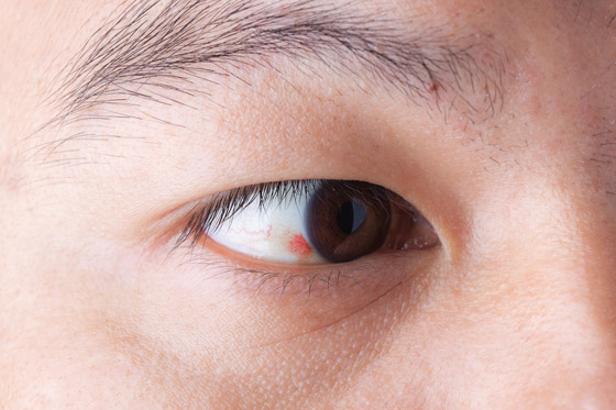 بقعة دم حمراء ظهرت في عينك فجأة؟ إلى ماذا تشير وما أسبابها وعلاجها؟ صورة رقم 1