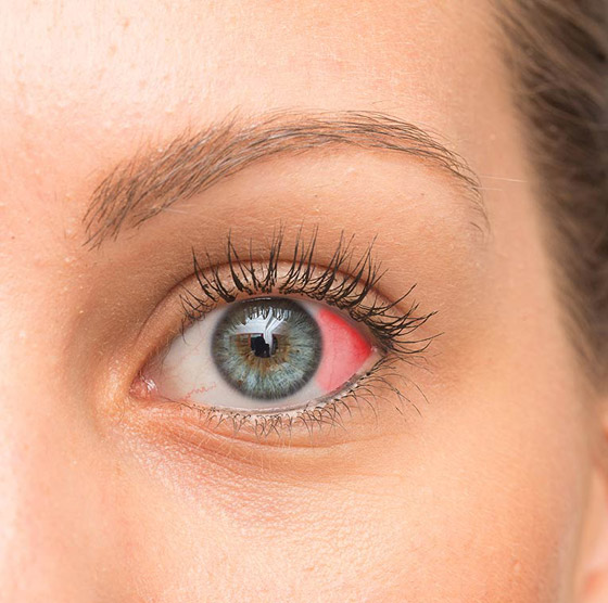 بقعة دم حمراء ظهرت في عينك فجأة؟ إلى ماذا تشير وما أسبابها وعلاجها؟ صورة رقم 10