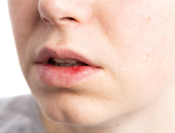 ما الذي يسبب تقرحات الفم واللسان المؤلمة وما علاجها؟ صورة رقم 2