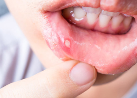 ما الذي يسبب تقرحات الفم واللسان المؤلمة وما علاجها؟ صورة رقم 3