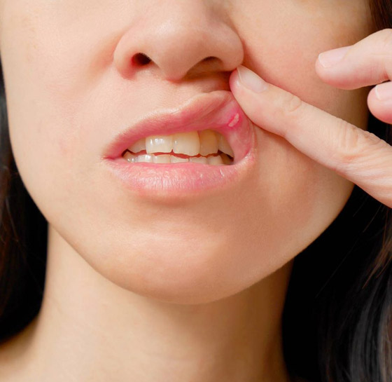 ما الذي يسبب تقرحات الفم واللسان المؤلمة وما علاجها؟ صورة رقم 5