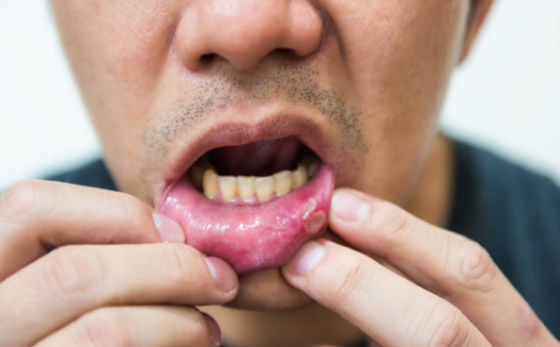 ما الذي يسبب تقرحات الفم واللسان المؤلمة وما علاجها؟ صورة رقم 6