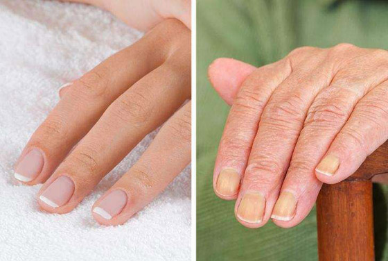 تعرفوا إلى 7 أجزاء في الجسم تكشف عن التقدم في العمر..! صورة رقم 2 تعرفوا إلى 7 أجزاء في الجسم تكشف عن التقدم في العمر..! صورة رقم 2