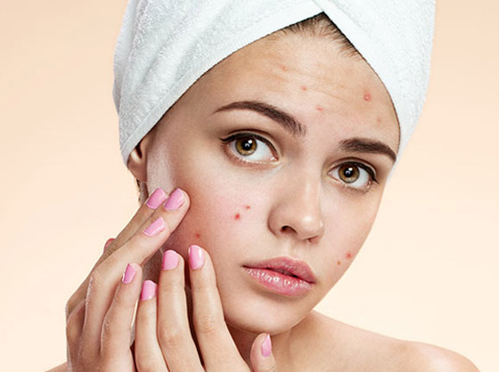 تعاني من بثور الوجه؟ إليك الدليل الشامل لأنواعها وأسبابها وعلاجاتها صورة رقم 6