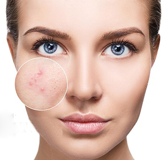 تعاني من بثور الوجه؟ إليك الدليل الشامل لأنواعها وأسبابها وعلاجاتها صورة رقم 9