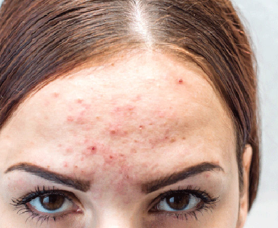 تعاني من بثور الوجه؟ إليك الدليل الشامل لأنواعها وأسبابها وعلاجاتها صورة رقم 8