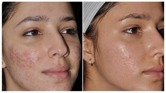 حُفر الوجه.. أسبابها وطرق علاجها والوقاية منها! صورة رقم 2