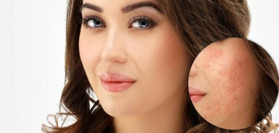 حُفر الوجه.. أسبابها وطرق علاجها والوقاية منها! صورة رقم 3