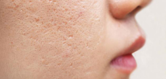 حُفر الوجه.. أسبابها وطرق علاجها والوقاية منها! صورة رقم 1