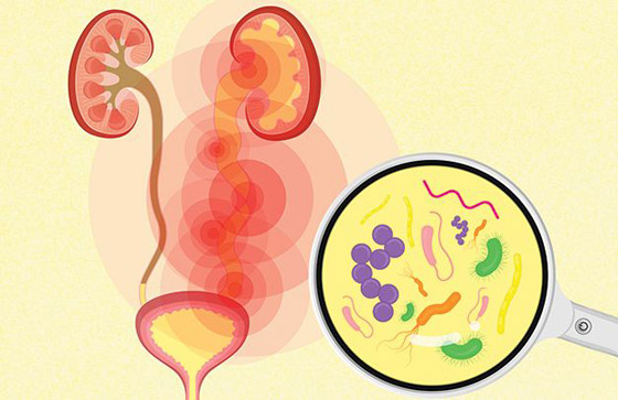 إليكم كل ما تريدون معرفته عن أعراض وأسباب أمراض المثانة المتعددة صورة رقم 5