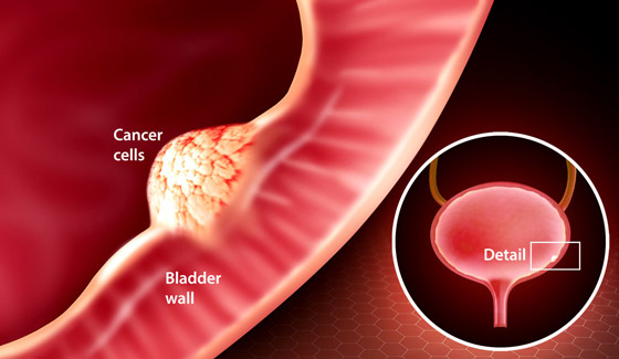 إليكم كل ما تريدون معرفته عن أعراض وأسباب أمراض المثانة المتعددة صورة رقم 19